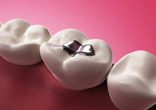 Emergenza mercurio: l’Unione europea corre ai ripari limitando l'uso dell'amalgama